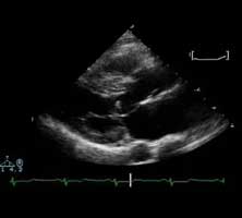 Echocardiografische opname van een hart met HOCM.